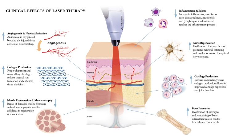 effects laser therapy